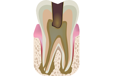 tooth3